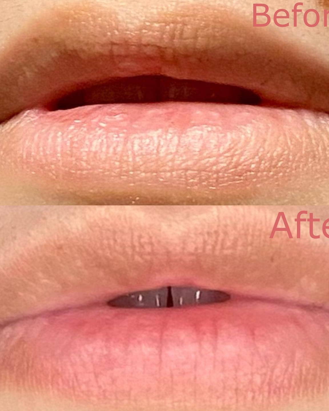 Before and after images showing the results of Served Chilled Rosé Lips Gels on lips.