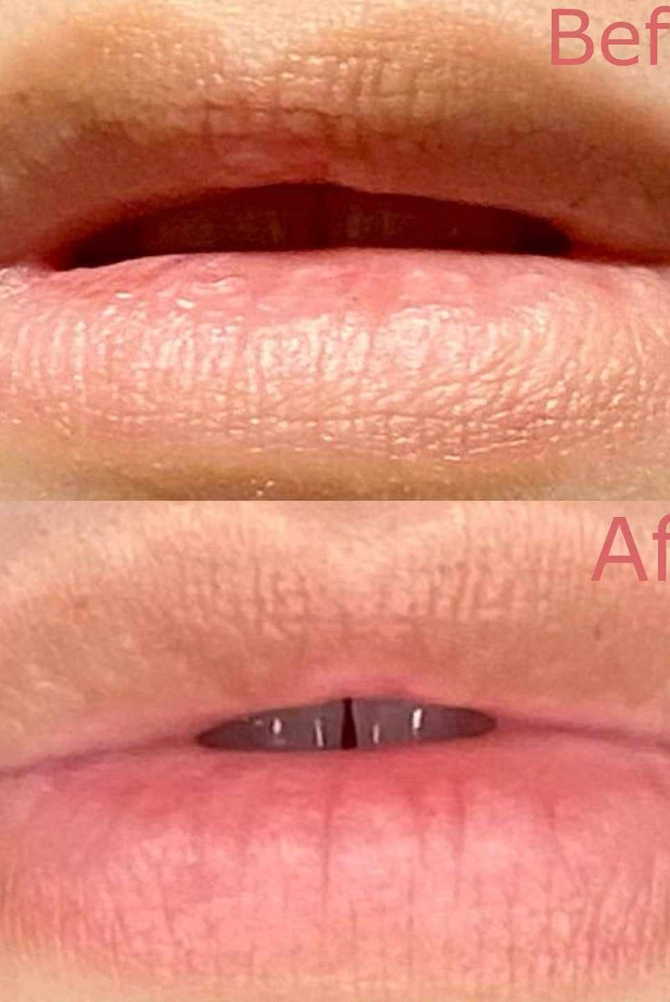 Before and after images showing the results of Served Chilled Rosé Lips Gels on lips.