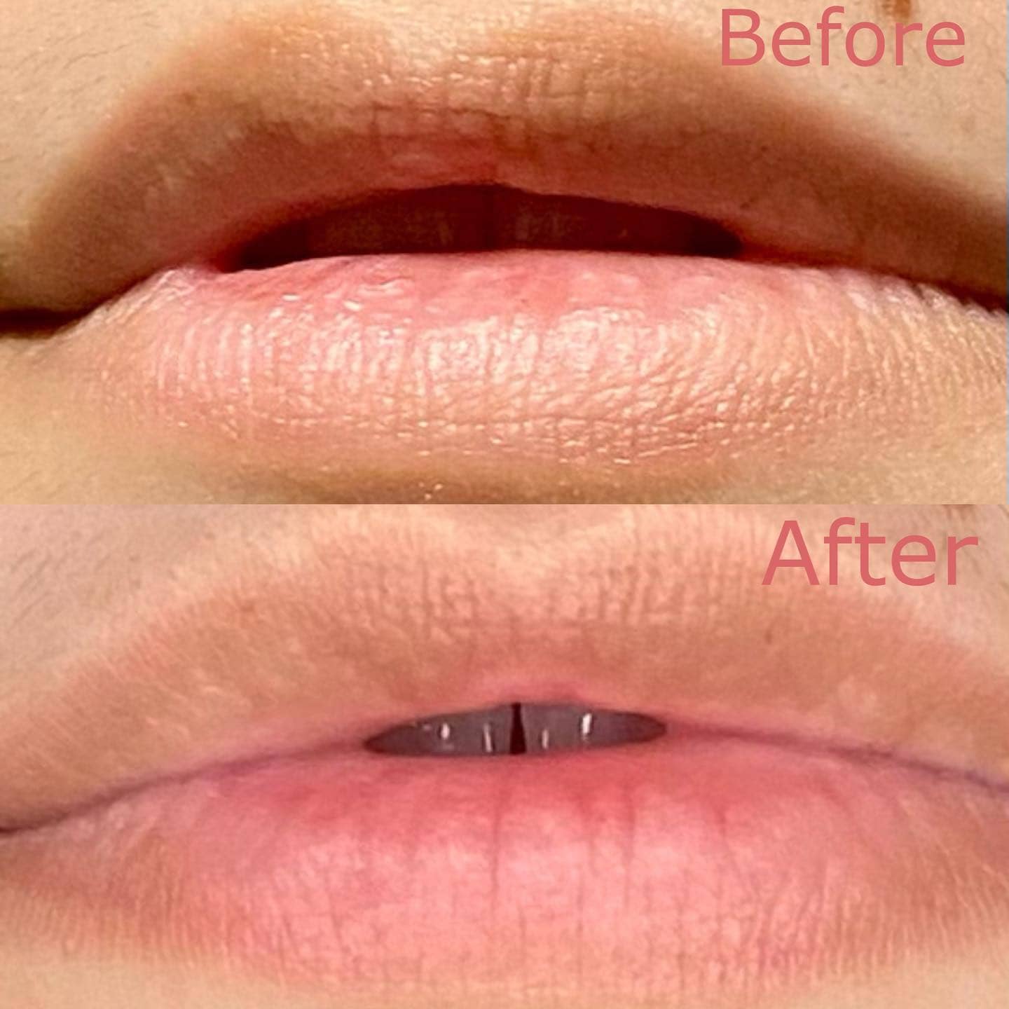 Before and after images showing the results of Served Chilled Rosé Lips Gels on lips.